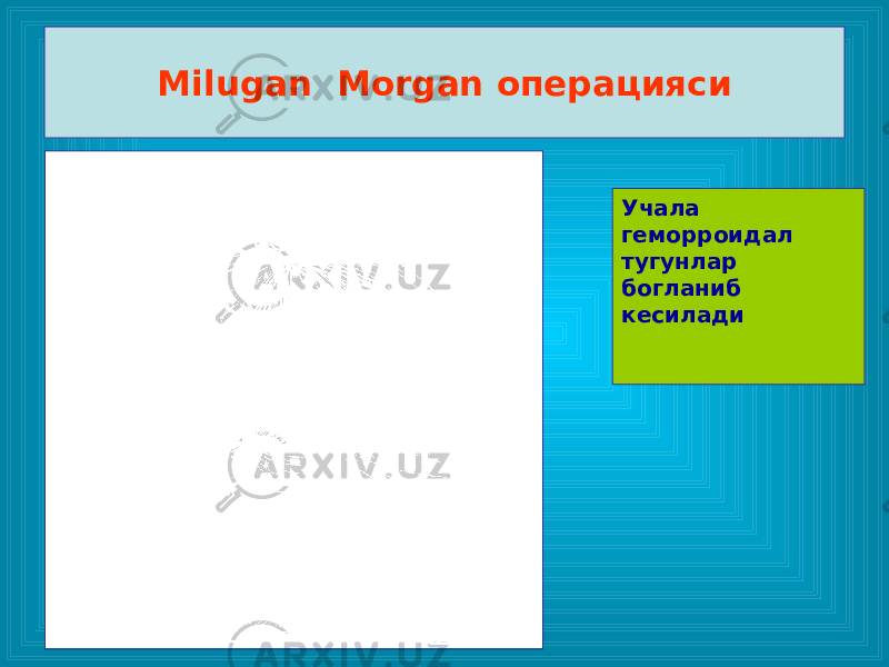 Milugan Morgan операцияси Учала геморроидал тугунлар богланиб кесилади 