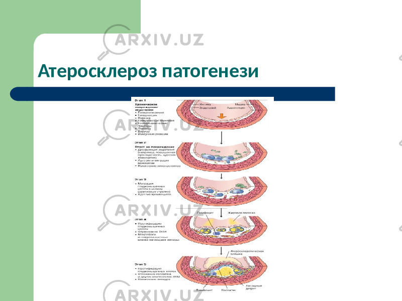 Атеросклероз патогенези 