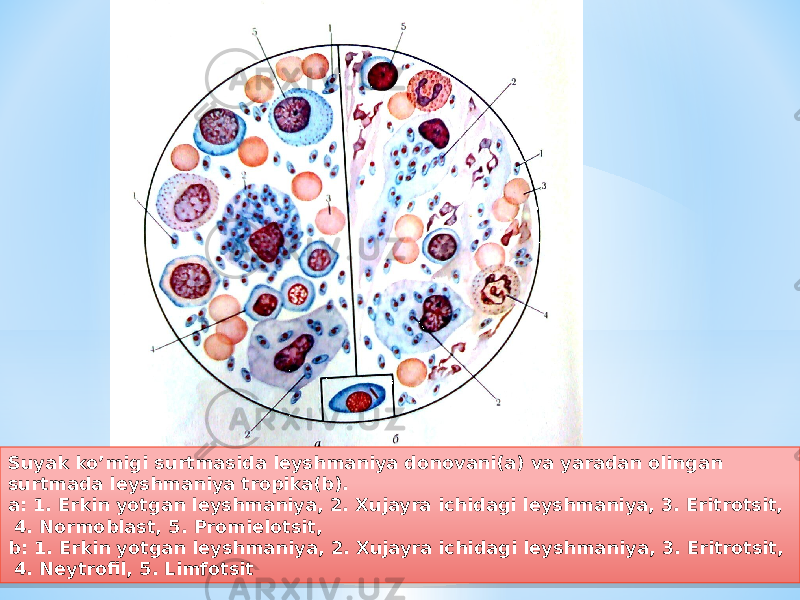 Suyak koʼmigi surtmasida leyshmaniya donovani(a) va yaradan olingan surtmada leyshmaniya tropika(b). a: 1. Erkin yotgan leyshmaniya, 2. Xujayra ichidagi leyshmaniya, 3. Eritrotsit, 4. Normoblast, 5. Promielotsit, b: 1. Erkin yotgan leyshmaniya, 2. Xujayra ichidagi leyshmaniya, 3. Eritrotsit, 4. Neytrofil, 5. Limfotsit2E 03 072F 09 33 1F 09 33 