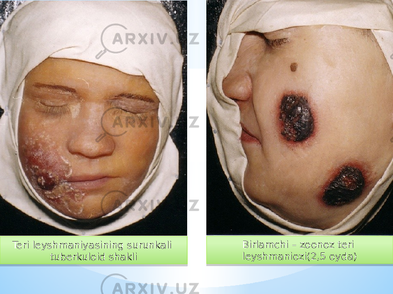 Teri leyshmaniyasining surunkali tuberkuloid shakli Birlamchi – zoonoz teri leyshmaniozi(2,5 oyda)24 0C 2F 0A 