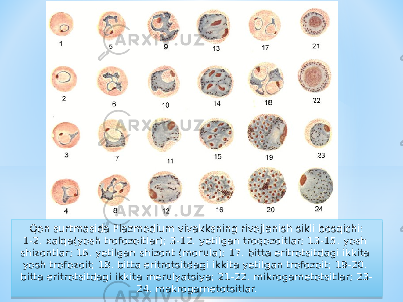 Qon surtmasida Plazmodium vivakksning rivojlanish sikli bosqichi: 1-2. xalqa(yosh trofozoitlar); 3-12. yetilgan troqozoitlar; 13-15. yosh shizontlar; 16. yetilgan shizont (morula); 17. bitta eritrotsitdagi ikkita yosh trofozoit; 18. bitta eritrotsitdagi ikkita yetilgan trofozoit; 19-20. bitta eritrotsitdagi ikkita merulyatsiya; 21-22. mikrogametotsitlar; 23- 24. makrogametotsitlar.3C 3F 1E 07 1C 13 