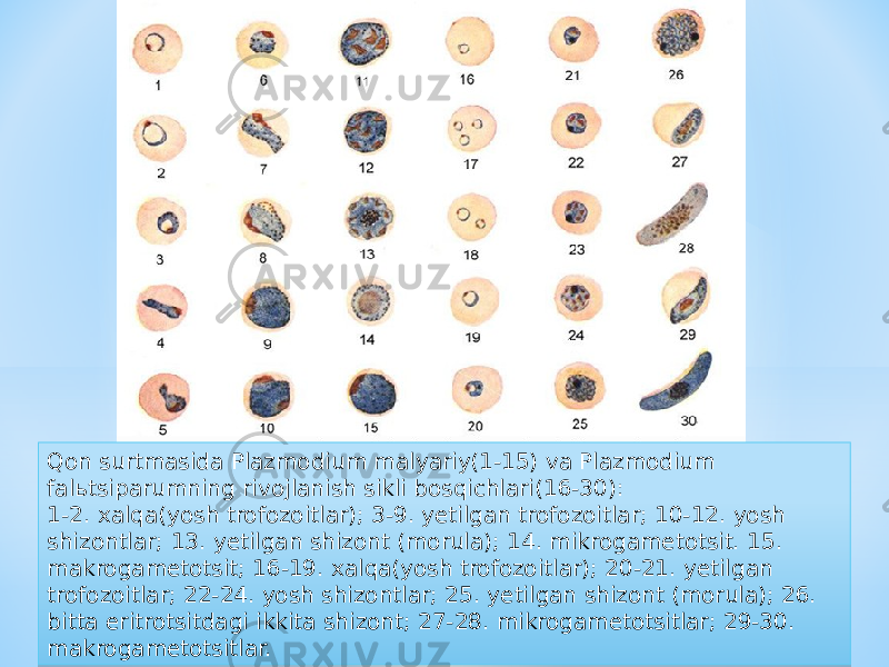 Qon surtmasida Plazmodium malyariy(1-15) va Plazmodium falьtsiparumning rivojlanish sikli bosqichlari(16-30): 1-2. xalqa(yosh trofozoitlar); 3-9. yetilgan trofozoitlar; 10-12. yosh shizontlar; 13. yetilgan shizont (morula); 14. mikrogametotsit. 15. makrogametotsit; 16-19. xalqa(yosh trofozoitlar); 20-21. yetilgan trofozoitlar; 22-24. yosh shizontlar; 25. yetilgan shizont (morula); 26. bitta eritrotsitdagi ikkita shizont; 27-28. mikrogametotsitlar; 29-30. makrogametotsitlar.3C 21 3F 1E 17 0C 1C 17 