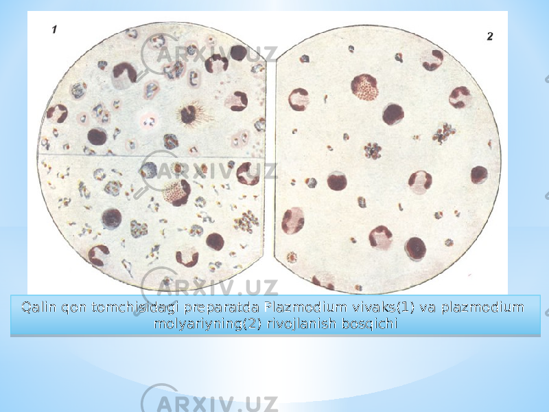 Qalin qon tomchisidagi preparatda Plazmodium vivaks(1) va plazmodium molyariyning(2) rivojlanish bosqichi3C 17 