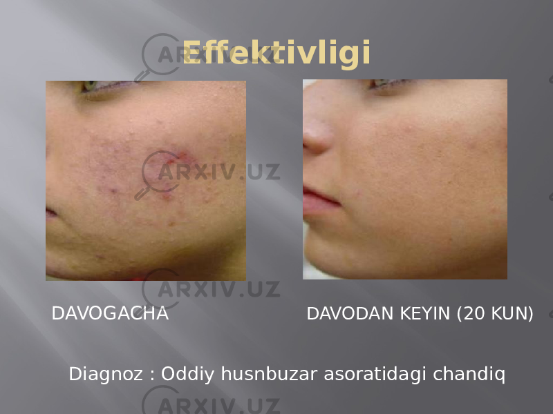 Effektivligi DAVOGACHA DAVODAN KEYIN (20 KUN) Diagnoz : Oddiy husnbuzar asoratidagi chandiq 