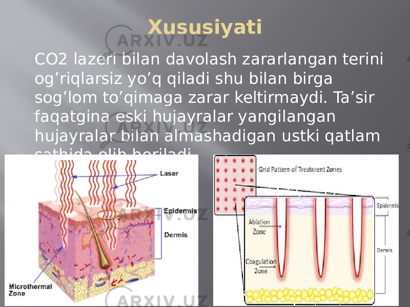 Xususiyati CO2 lazeri bilan davolash zararlangan terini og’riqlarsiz yo’q qiladi shu bilan birga sog’lom to’qimaga zarar keltirmaydi. Ta’sir faqatgina eski hujayralar yangilangan hujayralar bilan almashadigan ustki qatlam sathida olib boriladi. 