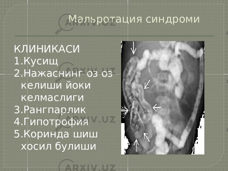 Мальротация синдроми КЛИНИКАСИ 1.Кусищ 2.Нажаснинг оз оз келиши йоки келмаслиги 3.Рангпарлик 4.Гипотрофия 5.Коринда шиш хосил булиши 