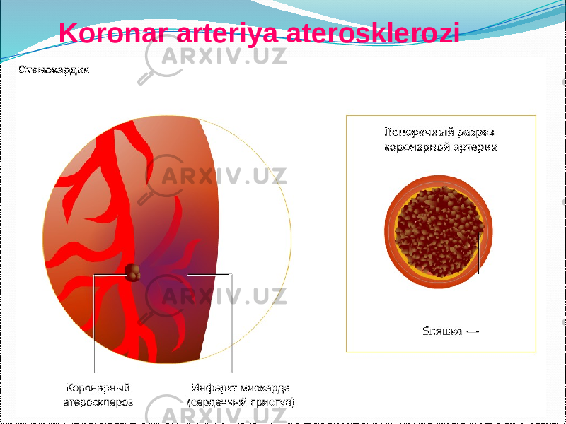  Koronar arteriya aterosklerozi 