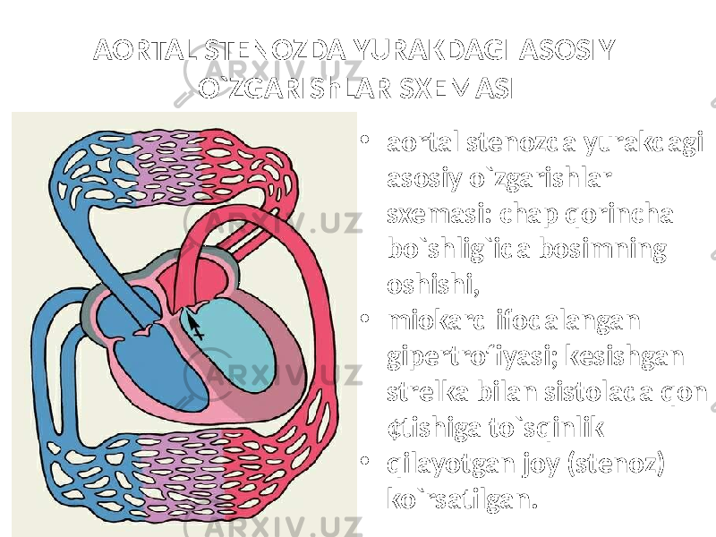 AORTAL STENOZDA YURAKDAGI ASOSIY O`ZGARIShLAR SXEMASI • aortal stenozda yurakdagi asosiy o`zgarishlar sxemasi: chap qorincha bo`shlig`ida bosimning oshishi, • miokard ifodalangan gipertrofiyasi; kesishgan strelka bilan sistolada qon ¢tishiga to`sqinlik • qilayotgan joy (stenoz) ko`rsatilgan. 