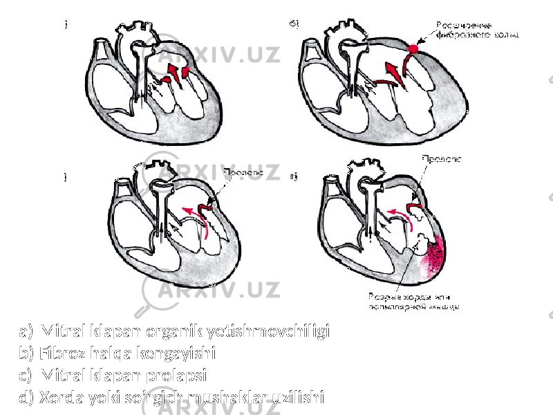 a) Mitral klapan organik yetishmovchiligi b) Fibroz halqa kengayishi c) Mitral klapan prolapsi d) Xorda yoki so’rgich mushaklar uzilishi 