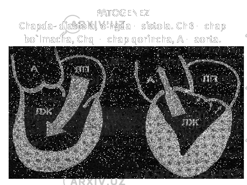 PATOGENEZ Chapda- diastola, o’ngda – sistola. ChB – chap bo`lmacha, Chq – chap qorincha, A – aorta. 