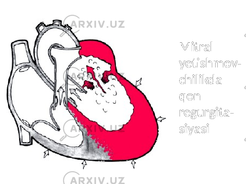 • Mitral yetishmov- chilikda qon regurgita- siyasi 