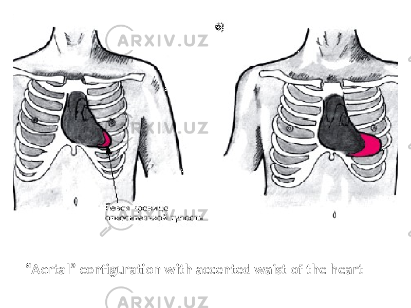 “ Aortal” configuration with accented waist of the heart 