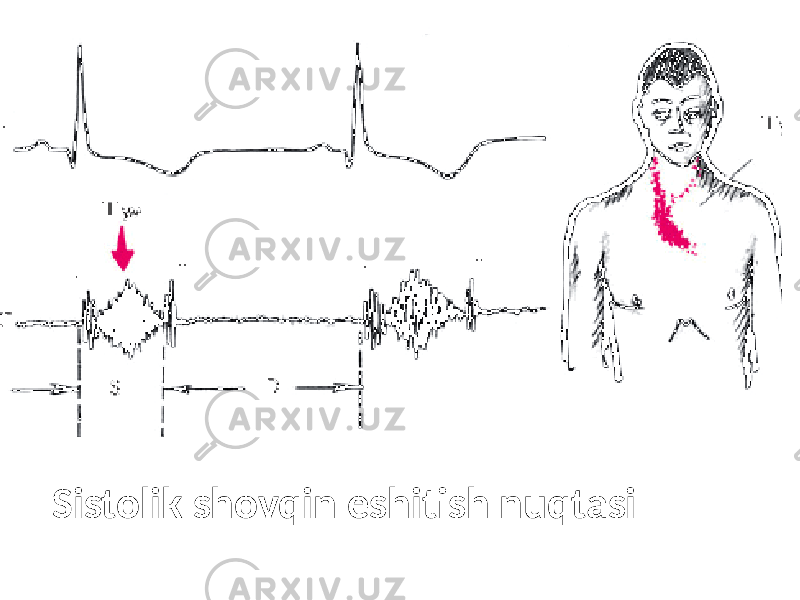 Sistolik shovqin eshitish nuqtasi 