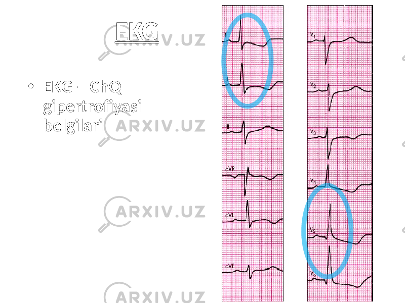 EKG • EKG – ChQ gipertrofiyasi belgilari 