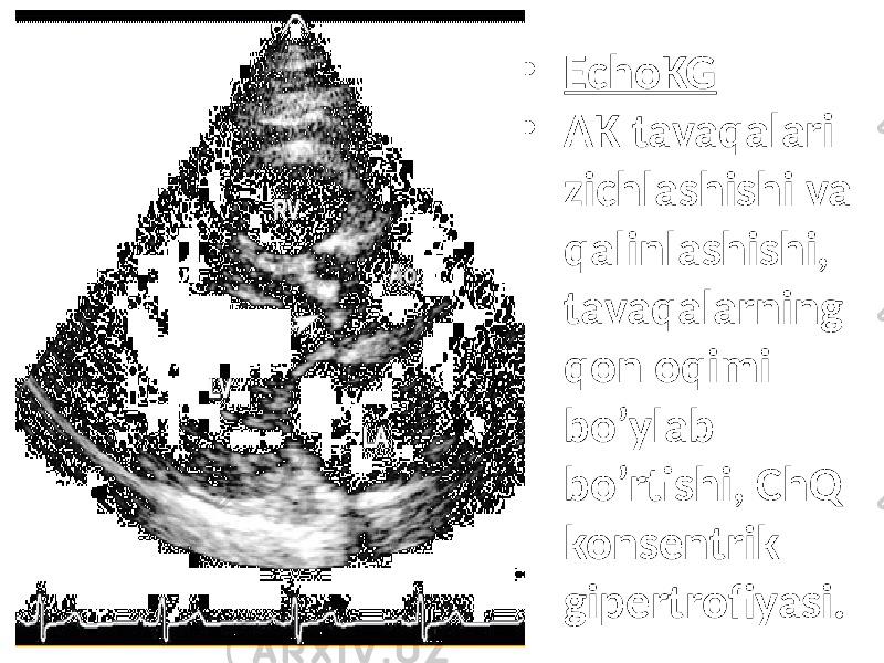 • EchoKG • AK tavaqalari zichlashishi va qalinlashishi, tavaqalarning qon oqimi bo’ylab bo’rtishi, ChQ konsentrik gipertrofiyasi. 