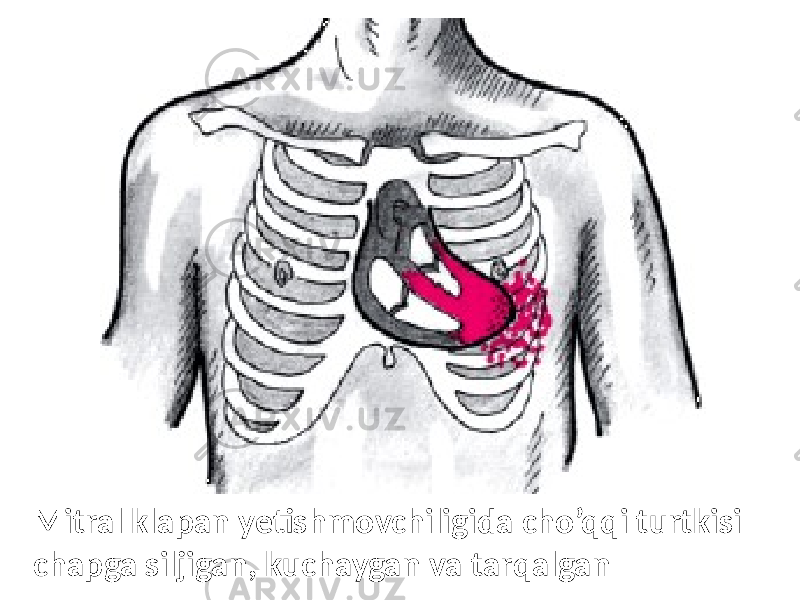 Mitral klapan yetishmovchiligida cho’qqi turtkisi chapga siljigan, kuchaygan va tarqalgan 