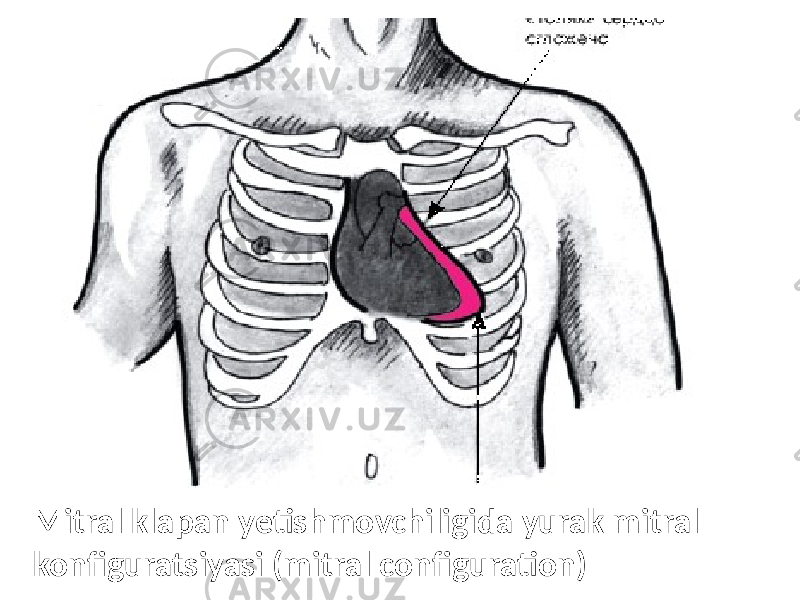 Mitral klapan yetishmovchiligida yurak mitral konfiguratsiyasi (mitral configuration) 