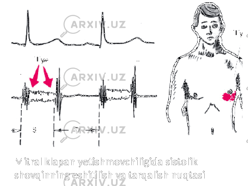 Mitral klapan yetishmovchiligida sistolik shovqinning eshitilish va tarqalish nuqtasi 