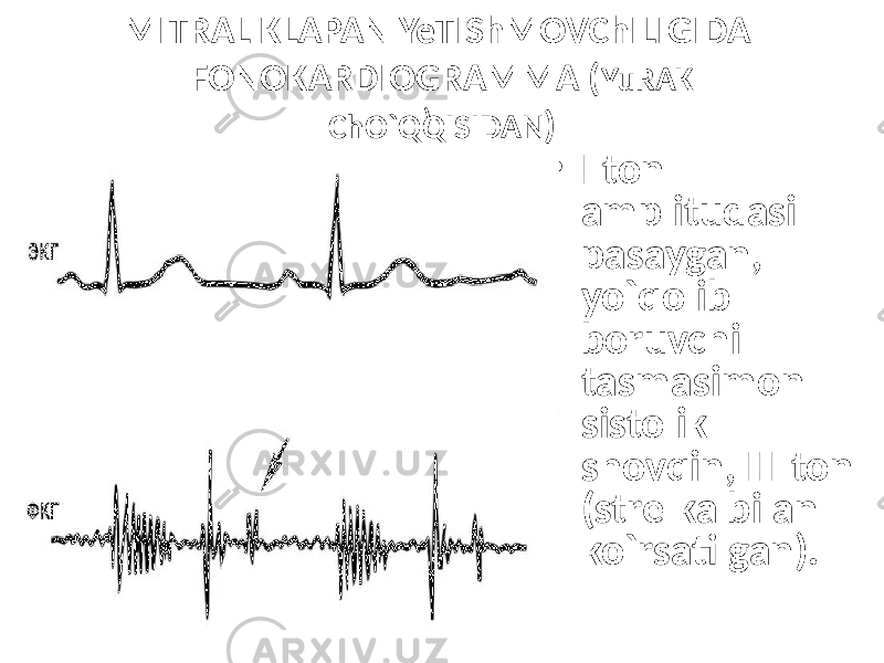 ) • I ton amplitudasi pasaygan, yo`qolib boruvchi tasmasimon sistolik shovqin, III ton (strelka bilan ko`rsatilgan). MITRAL KLAPAN YeTIShMOVChILIGIDA FONOKARDIOGRAMMA ( YuRAK ChO`QQISIDAN ) 