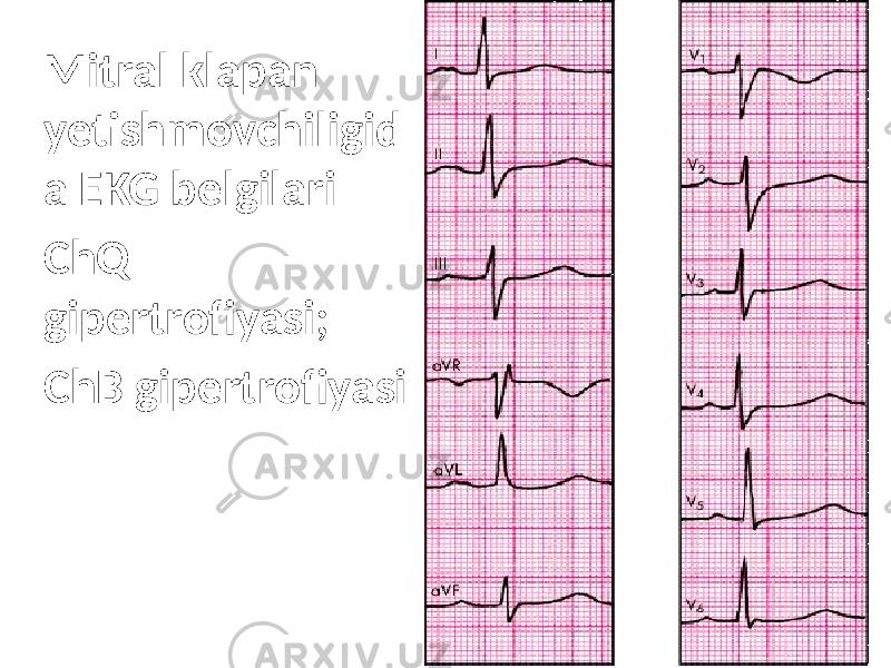 Mitral klapan yetishmovchiligid a EKG belgilari ChQ gipertrofiyasi; ChB gipertrofiyasi 