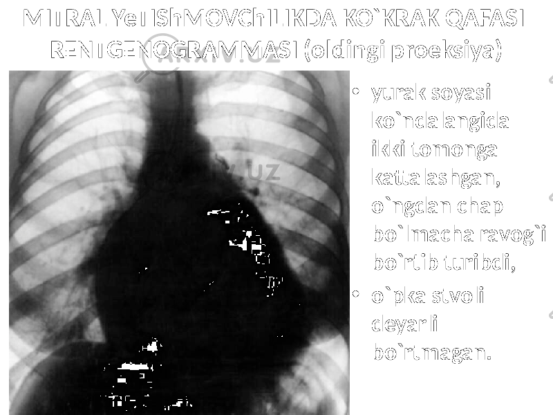 MITRAL YeTIShMOVChILIKDA KO`KRAK QAFASI RENTGENOGRAMMASI (oldingi proeksiya) • yurak soyasi ko`ndalangida ikki tomonga kattalashgan, o`ngdan chap bo`lmacha ravog`i bo`rtib turibdi, • o`pka stvoli deyarli bo`rtmagan. 