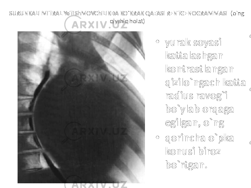 SURUNKALI MITRAL YeTIShMOVChILIKDA KO`KRAK QAFASI RENTGENOGRAMMASI (o`ng qiyshiq holat) • yurak soyasi kattalashgan kontrastlangan qizilo`ngach katta radius ravog`i bo`ylab orqaga egilgan, o`ng • qorincha o`pka konusi biroz bo`rtgan. 