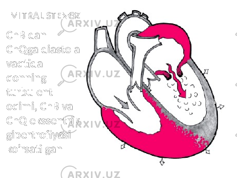 MITRAL STENOZ ChB dan ChQga diastola vaqtida qonning turbulent oqimi, ChB va ChQ ekssentrik gipertrofiyasi ko’rsatilgan 