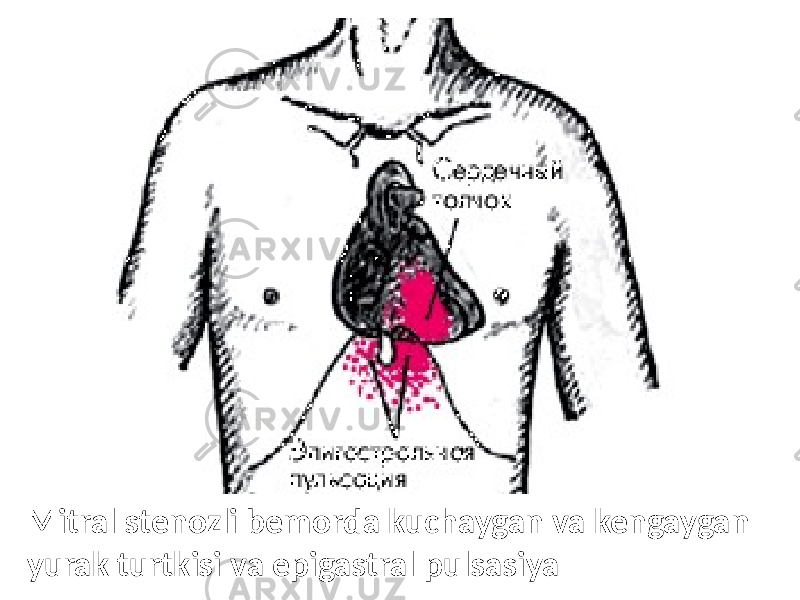 Mitral stenozli bemorda kuchaygan va kengaygan yurak turtkisi va epigastral pulsasiya 