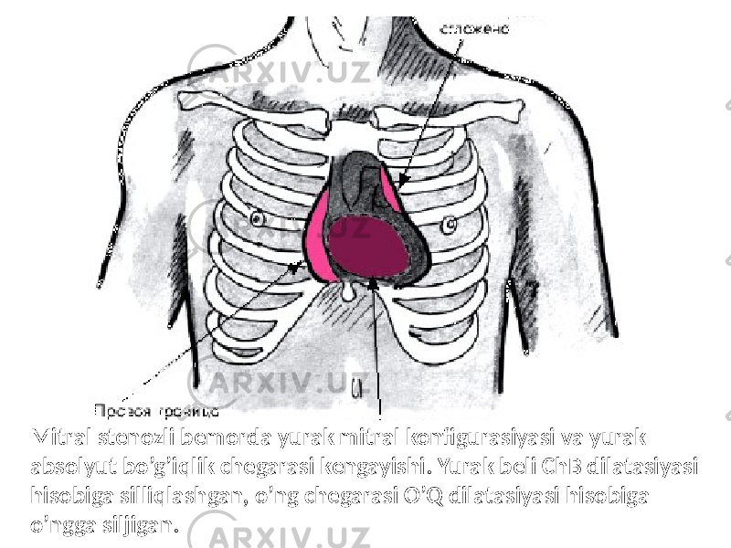 Mitral stenozli bemorda yurak mitral konfigurasiyasi va yurak absolyut bo’g’iqlik chegarasi kengayishi. Yurak beli ChB dilatasiyasi hisobiga silliqlashgan, o’ng chegarasi O’Q dilatasiyasi hisobiga o’ngga siljigan. 