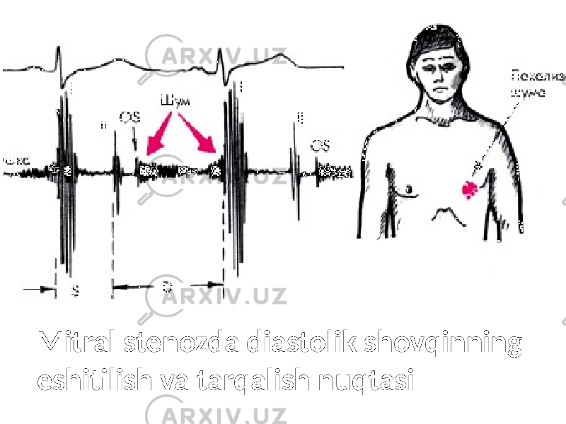 Mitral stenozda diastolik shovqinning eshitilish va tarqalish nuqtasi 