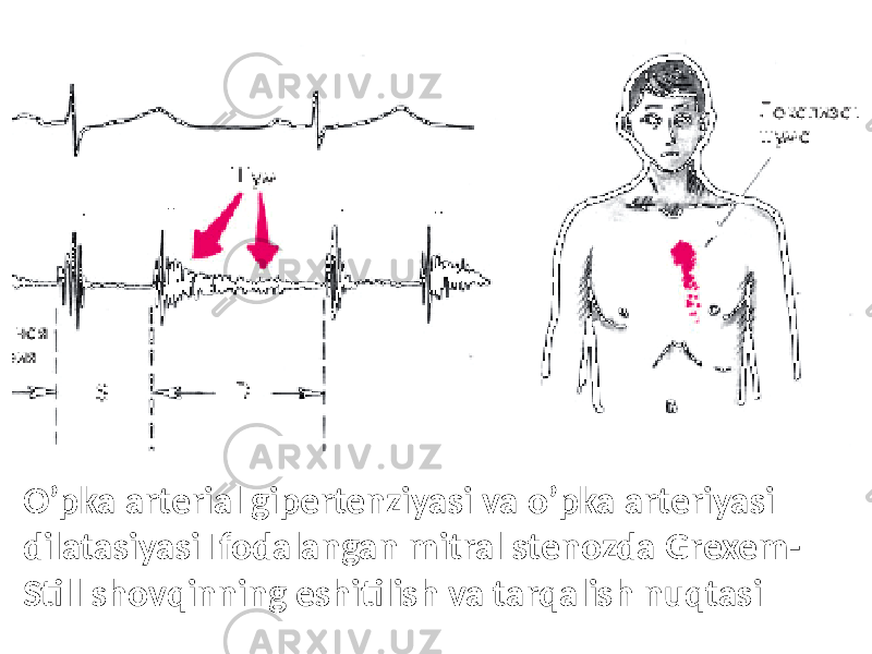 O’pka arterial gipertenziyasi va o’pka arteriyasi dilatasiyasi Ifodalangan mitral stenozda Grexem- Still shovqinning eshitilish va tarqalish nuqtasi 