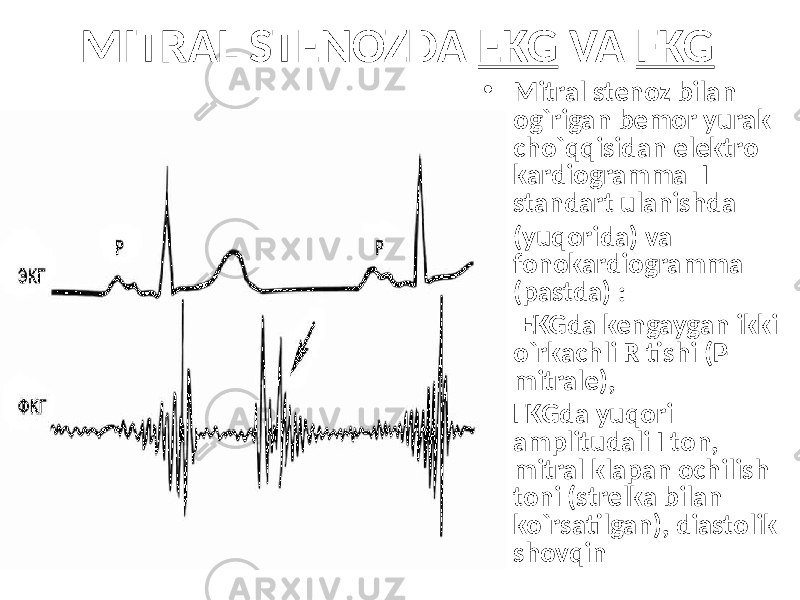 MITRAL STENOZDA EKG VA FKG • Mitral stenoz bilan og`rigan bemor yurak cho`qqisidan elektro kardiogramma I standart ulanishda • (yuqorida) va fonokardiogramma (pastda) : • EKGda kengaygan ikki o`rkachli R tishi (P- mitrale), • FKGda yuqori amplitudali I ton, mitral klapan ochilish toni (strelka bilan ko`rsatilgan), diastolik shovqin 