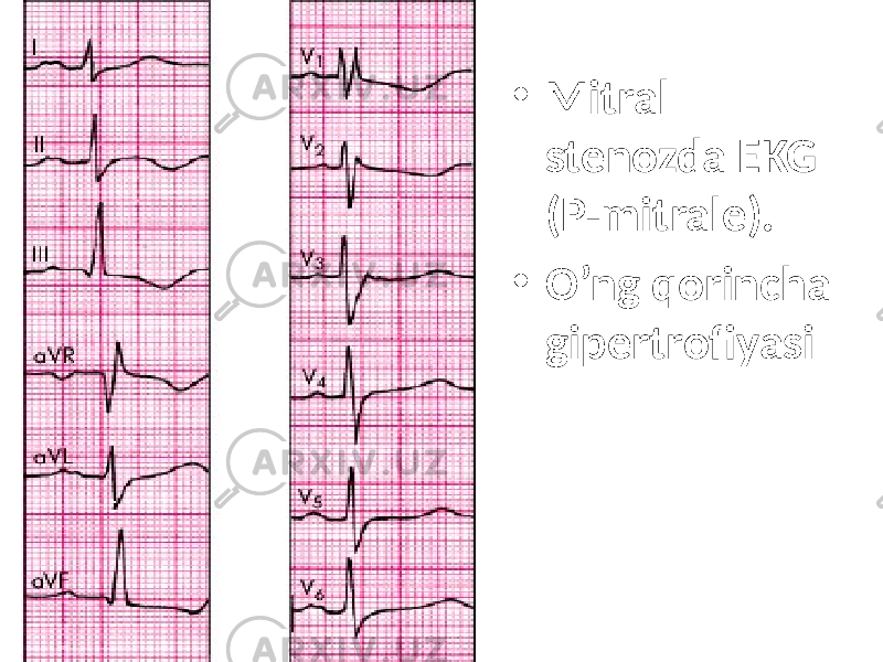 • Mitral stenozda EKG (P-mitrale). • O’ng qorincha gipertrofiyasi 