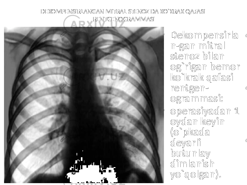 DEKOMPENSIRLANGAN MITRAL STENOZ DA KO`KRAK QAFASI RENTGENOGRAMMASI • Dekompensirla n-gan mitral stenoz bilan og`rigan bemor ko`krak qafasi rentgen- ogrammasi: • operasiyadan 1 oydan keyin (o`pkada deyarli butunlay dimlanish yo`qolgan). 