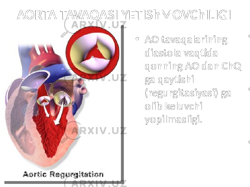 AORTA TAVAQASI YETIShMOVChILIGI • AO tavaqalarining diastola vaqtida qonning AO dan ChQ ga qaytishi (regurgitasiyasi) ga olib keluvchi yopilmasligi. 