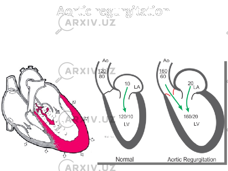 Aortic regurgitation 