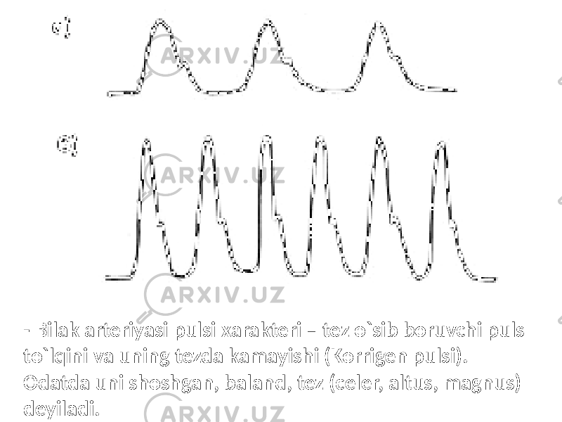 - Bilak arteriyasi pulsi xarakteri – tez o`sib boruvchi puls to`lqini va uning tezda kamayishi (Korrigen pulsi). Odatda uni shoshgan, baland, tez (celer, altus, magnus) deyiladi. 