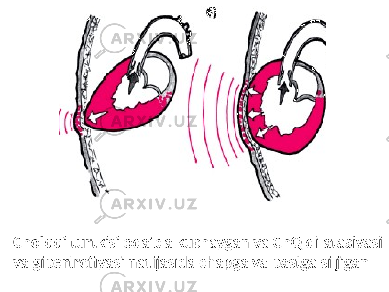 Cho`qqi turtkisi odatda kuchaygan va ChQ dilatasiyasi va gipertrofiyasi natijasida chapga va pastga siljigan 