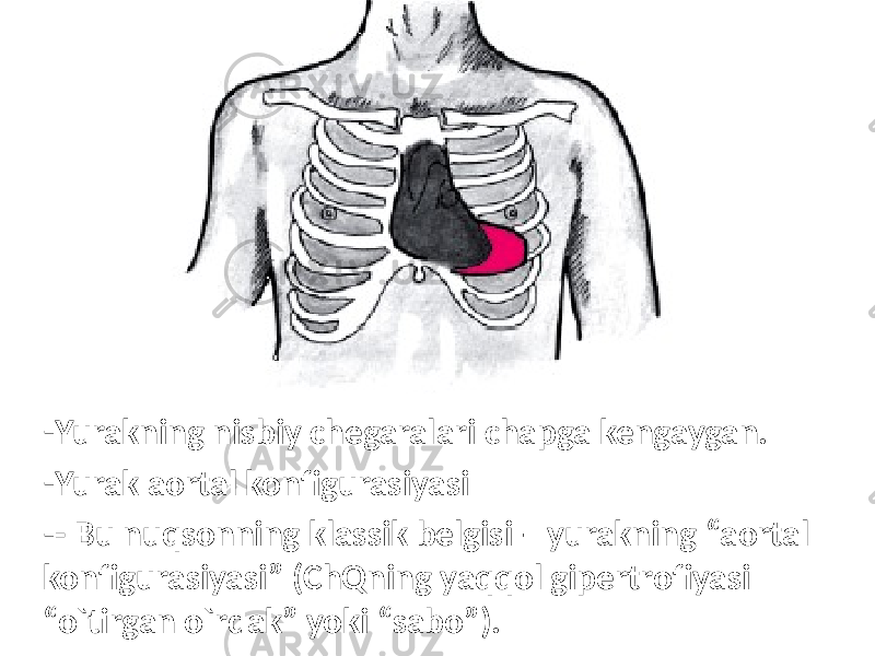 - Yurakning nisbiy chegaralari chapga kengaygan. - Yurak aortal konfigurasiyasi - - Bu nuqsonning klassik belgisi – yurakning “aortal konfigurasiyasi” (ChQning yaqqol gipertrofiyasi “o`tirgan o`rdak” yoki “sabo”). 