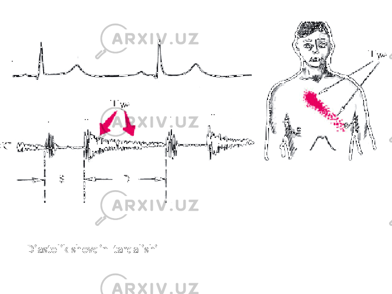 Diastolik shovqin tarqalishi 