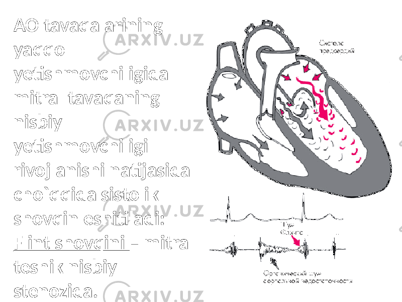 AO tavaqalarining yaqqol yetishmovchiligida mitral tavaqaning nisbiy yetishmovchiligi rivojlanishi natijasida cho`qqida sistolik shovqin eshitiladi: Flint shovqini – mitral teshik nisbiy stenozida. 