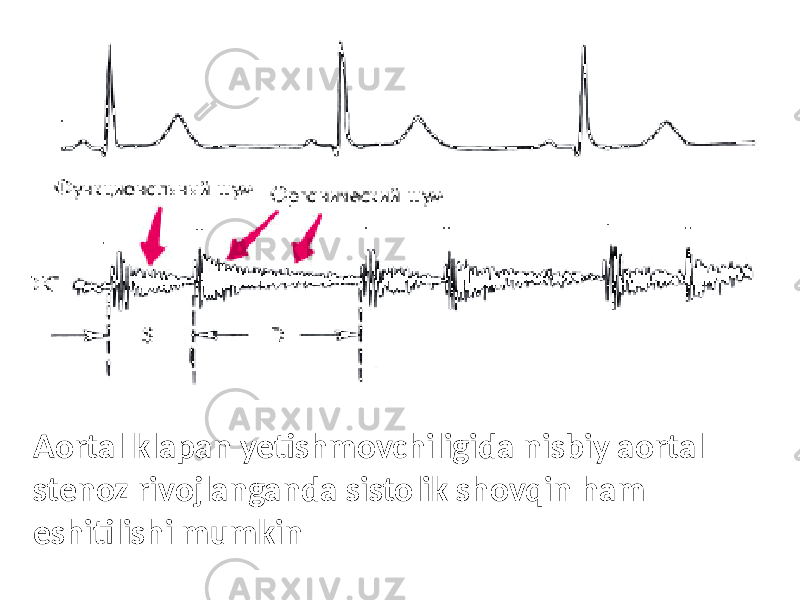 Aortal klapan yetishmovchiligida nisbiy aortal stenoz rivojlanganda sistolik shovqin ham eshitilishi mumkin 