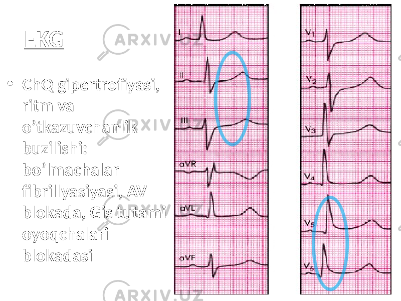 EKG • ChQ gipertrofiyasi, ritm va o’tkazuvchanlik buzilishi: bo’lmachalar fibrillyasiyasi, AV blokada, Gis tutami oyoqchalari blokadasi 