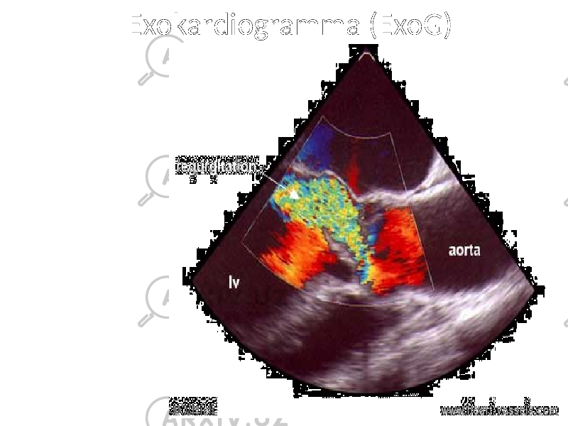 Exokardiogramma (ExoG) в двухмерном режиме – гипертрофия ЛЖ, в одномерном режиме – трепетание передней створки митрального клапана, при допплеровском исследовании регистрируют струю регургитации из аорты в ЛЖ 