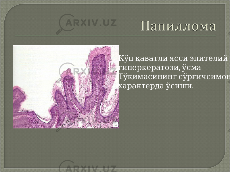  Кўп қаватли ясси эпителий , гиперкератози ўсма Тўқимасининг сўрғичсимон . характерда ўсиши 