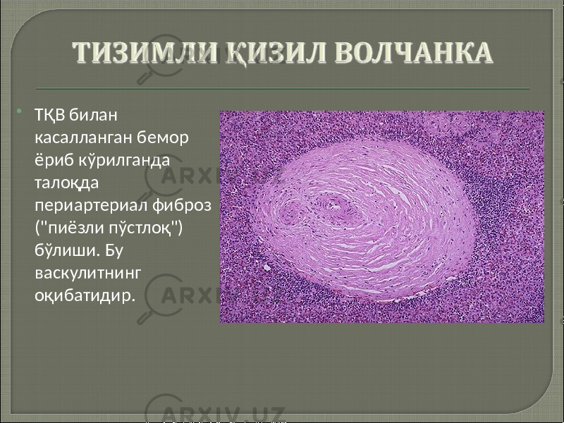  ТҚВ билан касалланган бемор ёриб кўрилганда талоқда периартериал фиброз (&#34;пиёзли пўстлоқ&#34;) бўлиши. Бу васкулитнинг оқибатидир. 