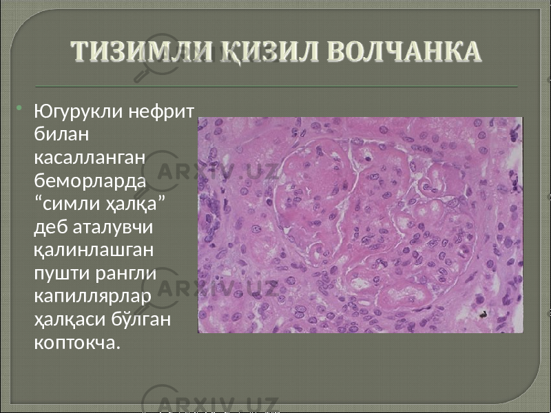  Югурукли нефрит билан касалланган беморларда “симли ҳалқа” деб аталувчи қалинлашган пушти рангли капиллярлар ҳалқаси бўлган коптокча. 