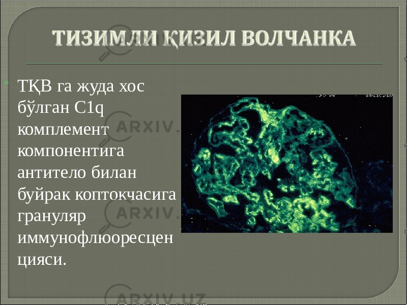  ТҚВ га жуда хос бўлган C1q комплемент компонентига антитело билан буйрак коптокчасига грануляр иммунофлюоресцен цияси. 