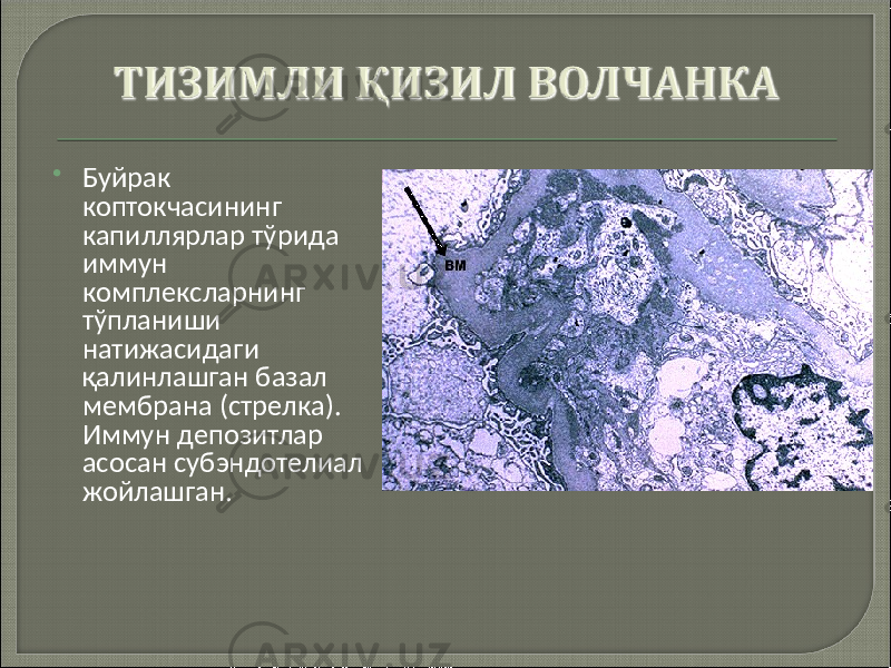  Буйрак коптокчасининг капиллярлар тўрида иммун комплексларнинг тўпланиши натижасидаги қалинлашган базал мембрана (стрелка). Иммун депозитлар асосан субэндотелиал жойлашган. 