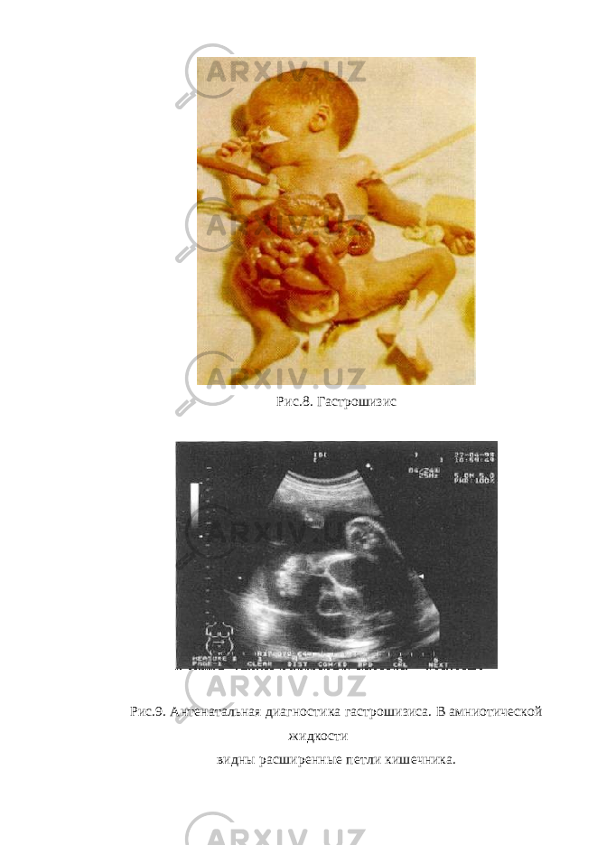 Рис.8. Гастрошизис Рис.9. Антенатальная диагностика гастрошизиса. В амниотической жидкости видны расширенные петли кишечника. 